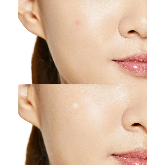 Cosrx Acne Pimple Master Patch 1 Pack (24pieces) - KOS